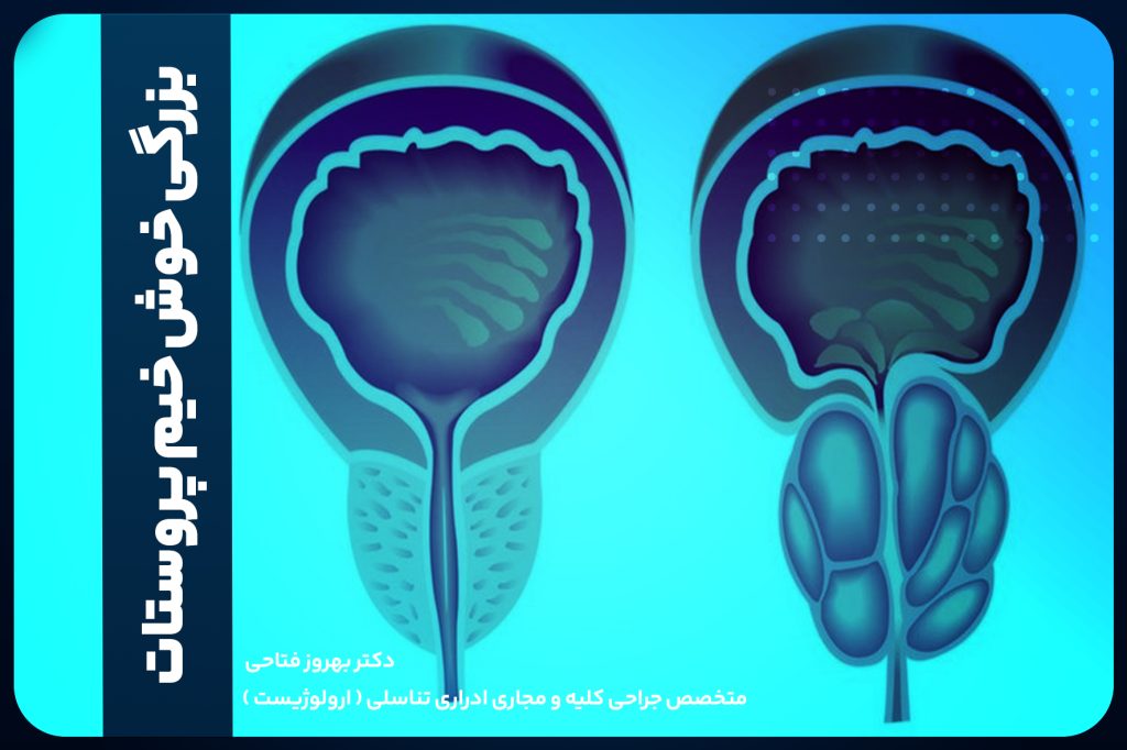 بزرگی خوش خیم پروستات