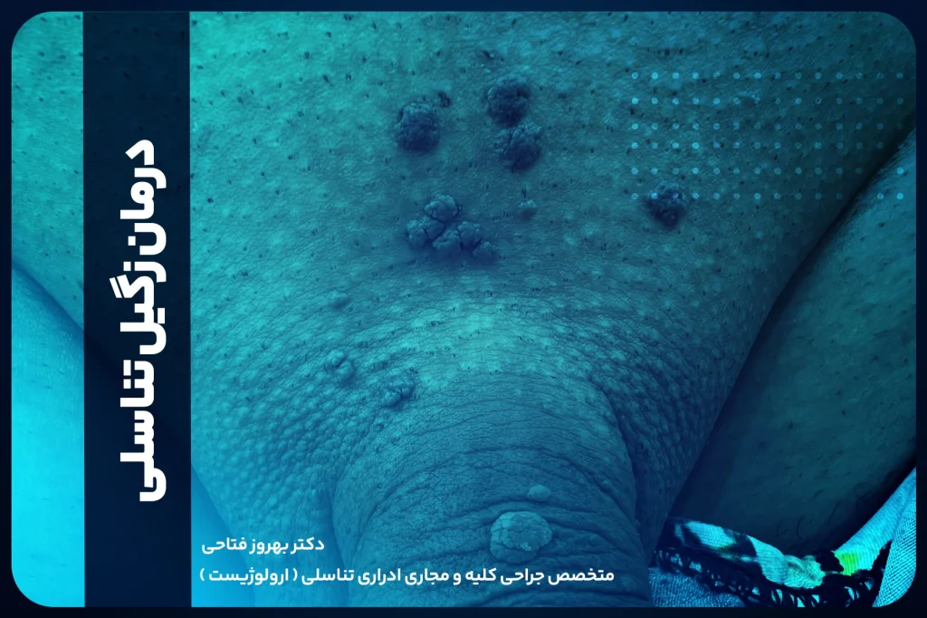 زگیل تناسلی