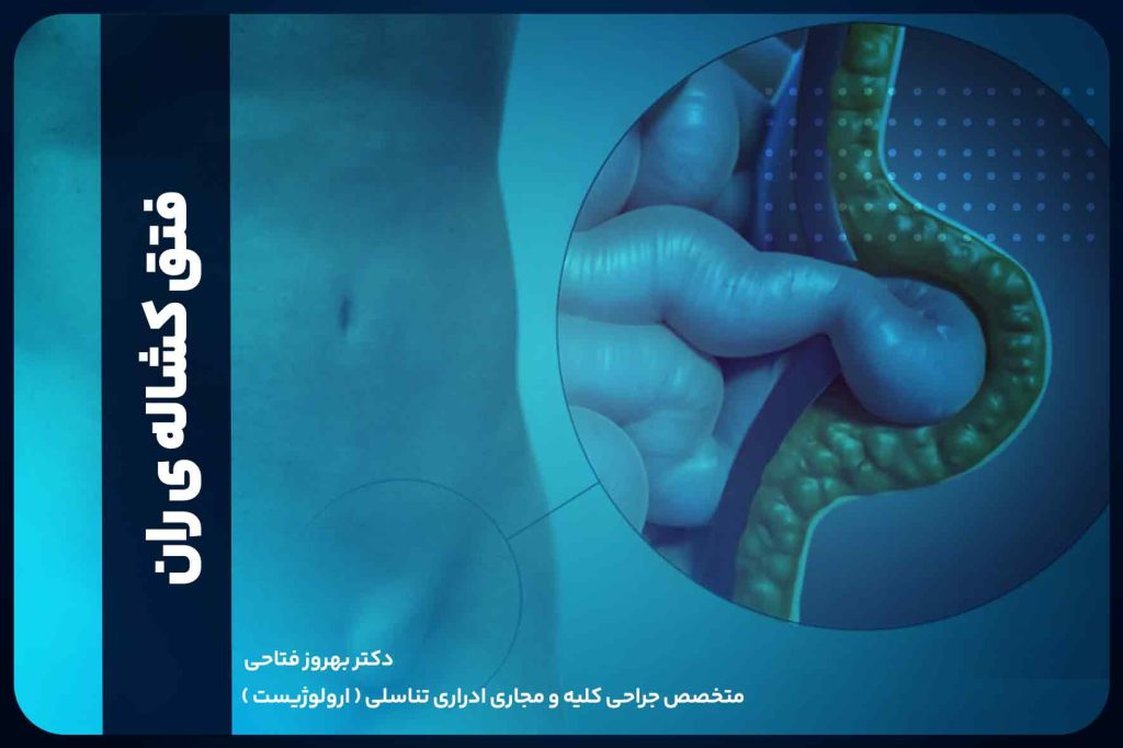 فتق کشاله ی ران