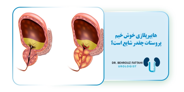 هایپرپلازی خوش خیم پروستات چقدر شایع است؟
