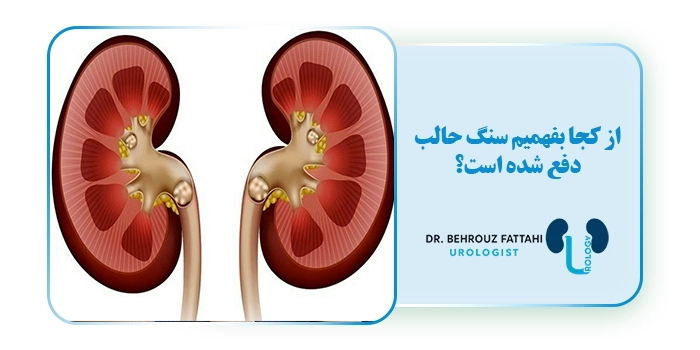 از کجا بفهمیم سنگ حالب دفع شده است؟