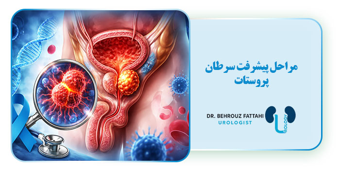 مراحل پیشرفت سرطان پروستات