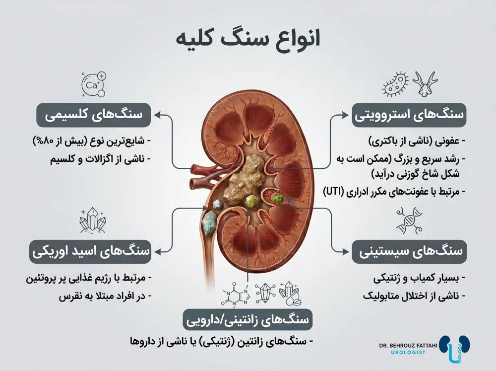 انواع سنگ کلیه