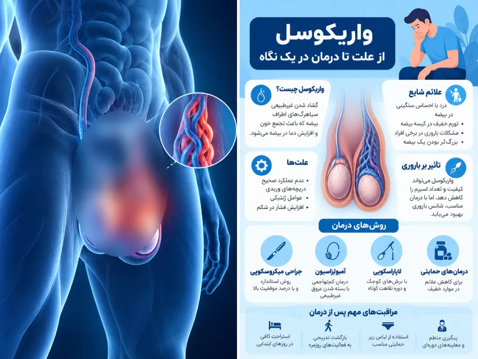 درمان واریکوسل